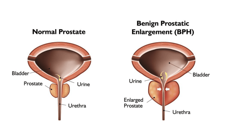 Normal Prostate vs Enlarged Prostate Normal Prostate vs Enlarged Prostate
